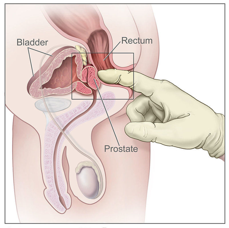 Vyšetření prostaty